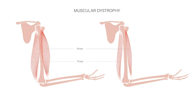 Muscular Dystrophies and Aging: The Facts
